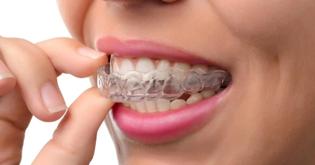 Clear aligners Liverpool