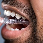 Invisalign for Busy Professionals: Straightening Teeth on a Hectic Schedule