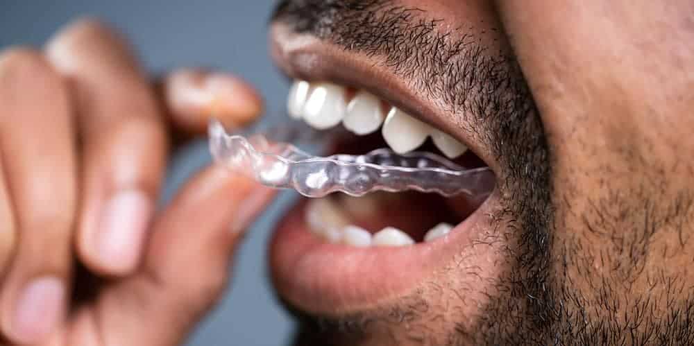 Invisalign for busy professionals