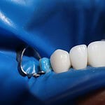 Important Aftercare Tips for All-on-4 Implants